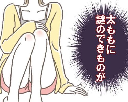 太ももにできものができた女性