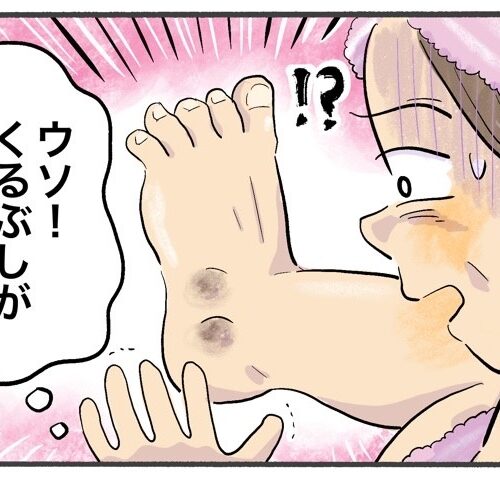 「くるぶしが2個？」長年放置した色素沈着と硬い皮膚に向き合ってみた結果【体験談】