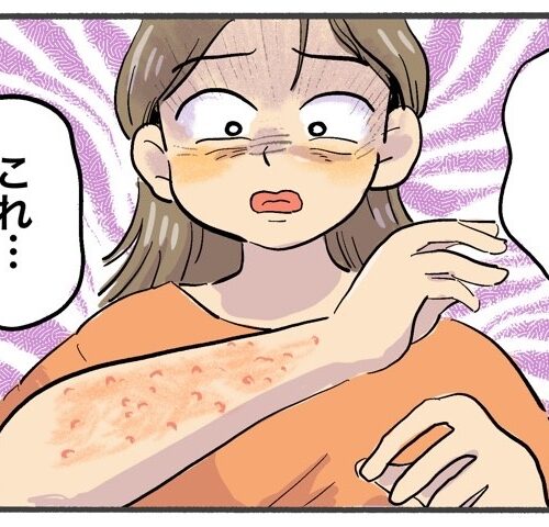 40代、目覚めると赤いボツボツがびっしり！？医師から告げられたまさかの診断【体験談】