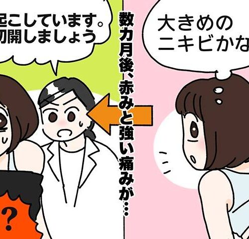 粉瘤ができた女性